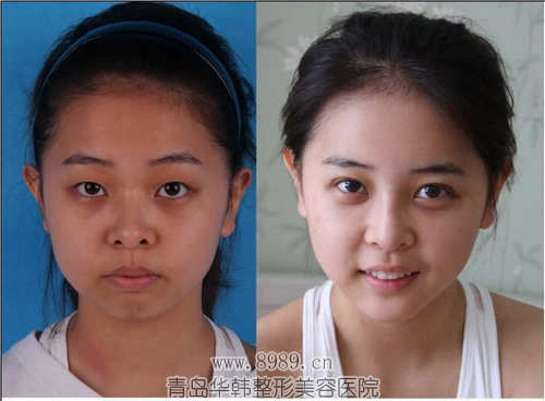 隆眉弓 成为立体美人的方式